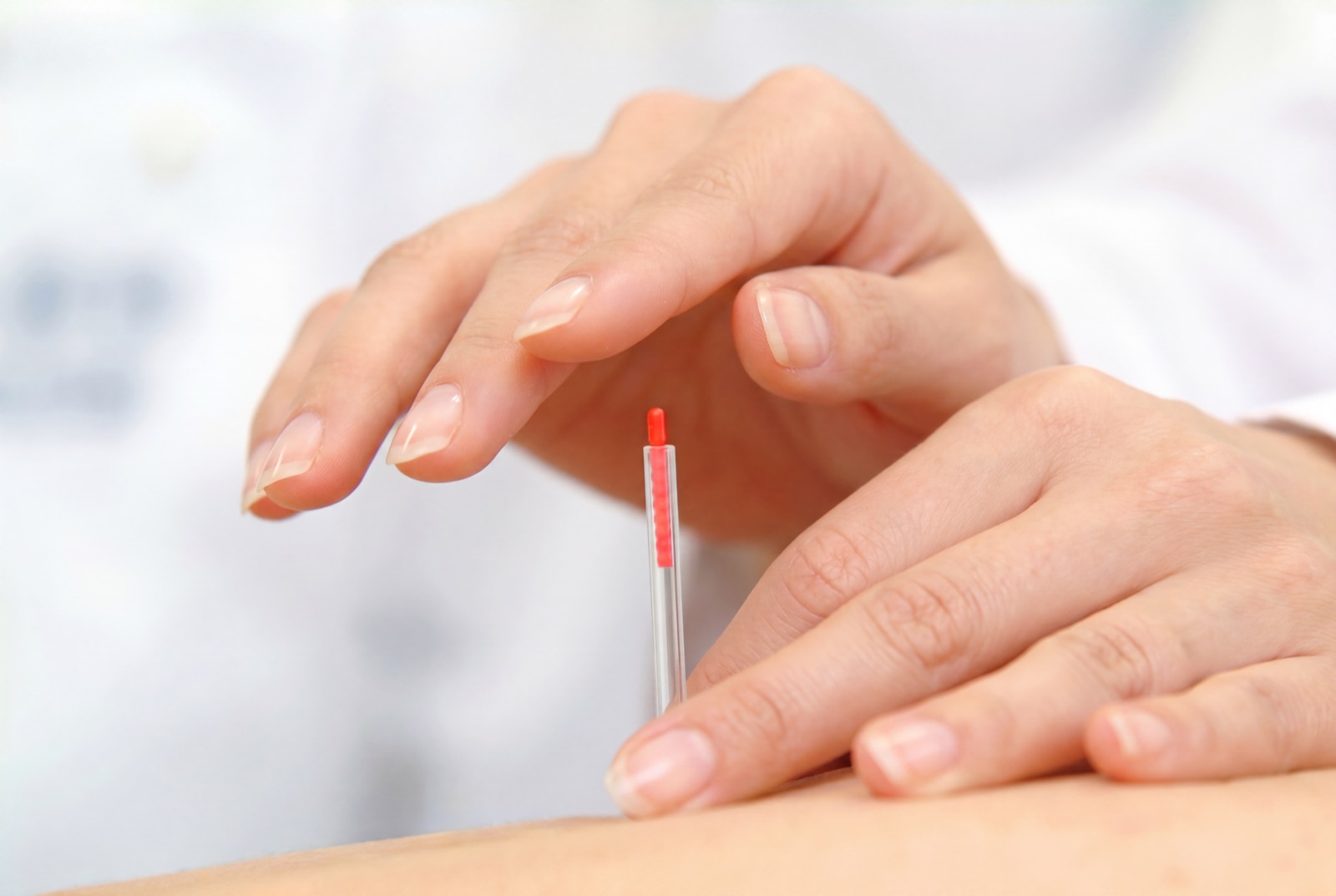 Acupuncture at LOOPLE Amsterdam Zuid
