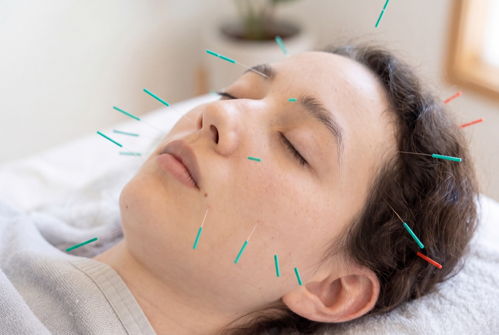 Cosmetic acupuncture